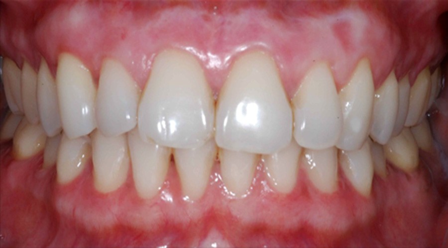 بعد تجميل وعلاج اللثة مركز دكتور ايمن الغمراوى لطب الاسنان 4